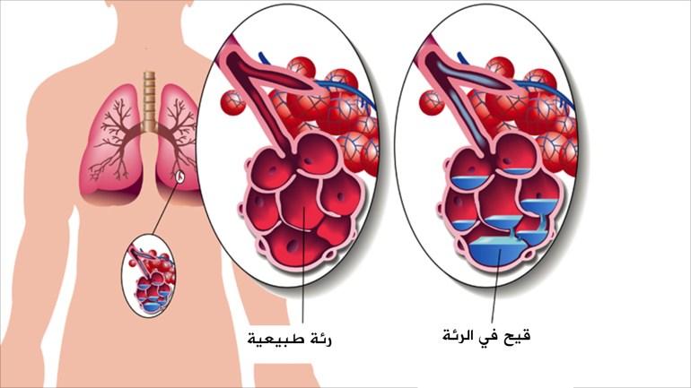 تصميم للالتهاب الرئوي، الوكالة الفرعية روب 3000