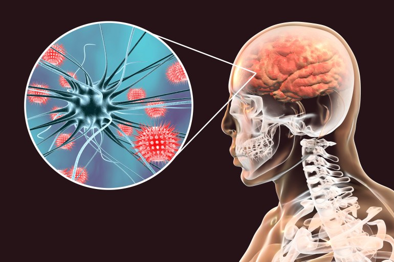 Viral meningitis and encephalitis, medical concept, 3D illustration showing brain infection and close-up view of viruses in the brain